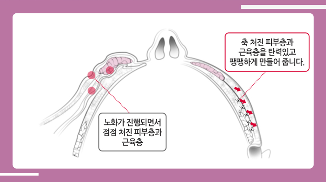 깊은 얼굴주름을 개선시켜주는 안면거상 관련 이미지 5