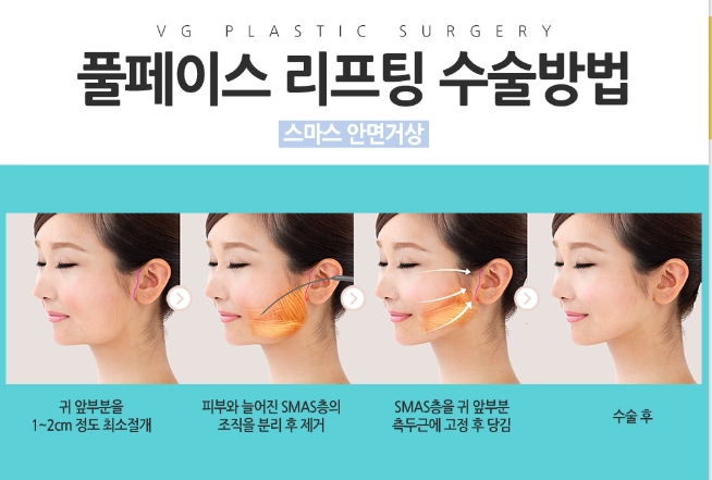 안면거상 깊은 주름에 효과적인 동안수술 관련 이미지 5
