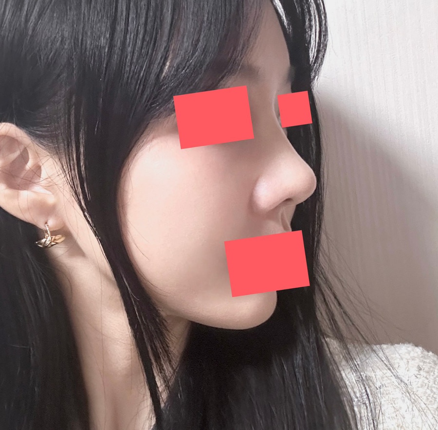 첫코수술 절골 기증늑연골 비중격교정술 하비갑개절제술 베리굿성형외과 코수술 후기 관련 이미지 2