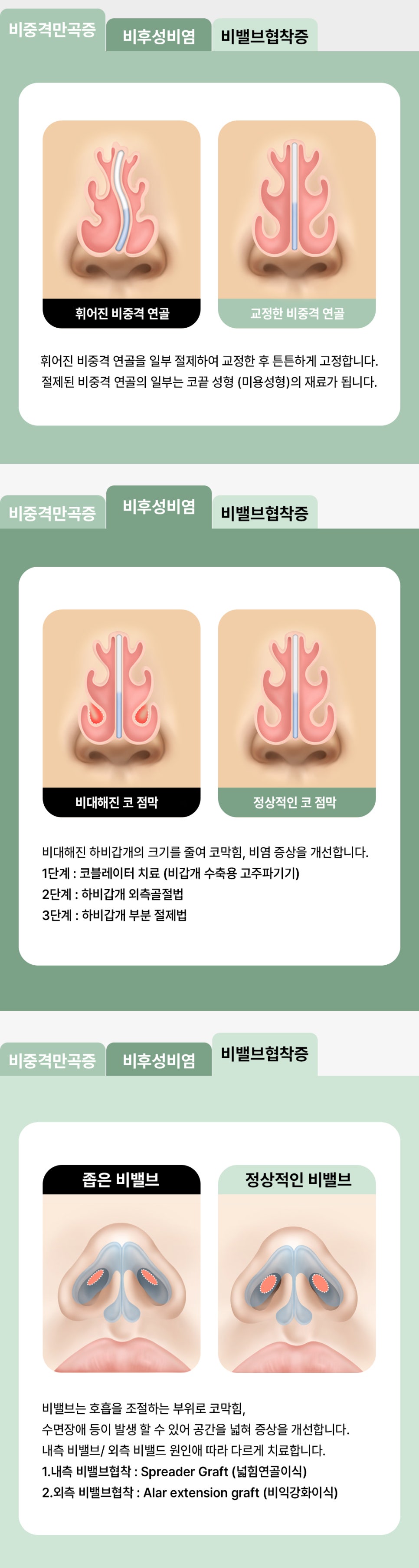 비염 수술과 코성형, 한 번에 가능할까? 기능코성형 전 알아야 할 점 관련 이미지 2