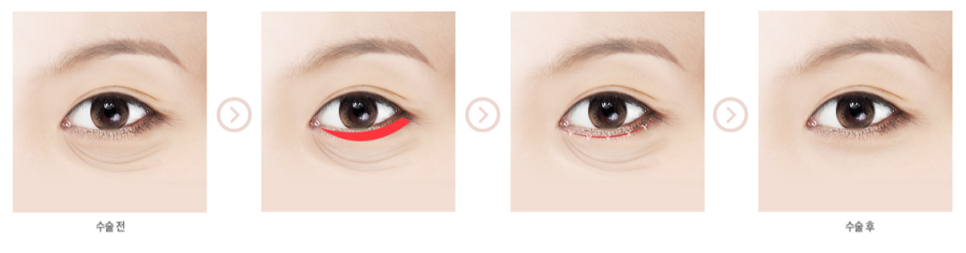 하안검으로 베리굿~하게 젊어지자! 관련 이미지 3