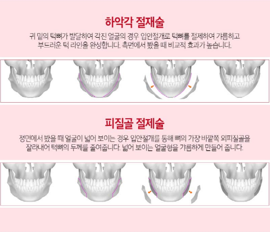 안면윤곽으로 작고 갸름한 얼굴형 만들자! 관련 이미지 4