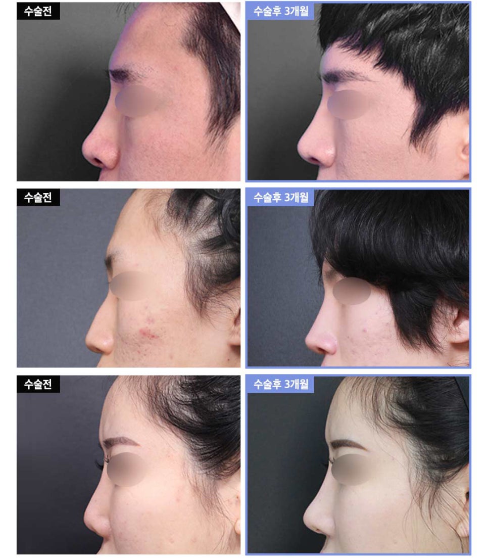 자가연골 코재수술, 기능코 또는 비염까지 한번에 해결 / 강남역 이비인후과 관련 이미지 7