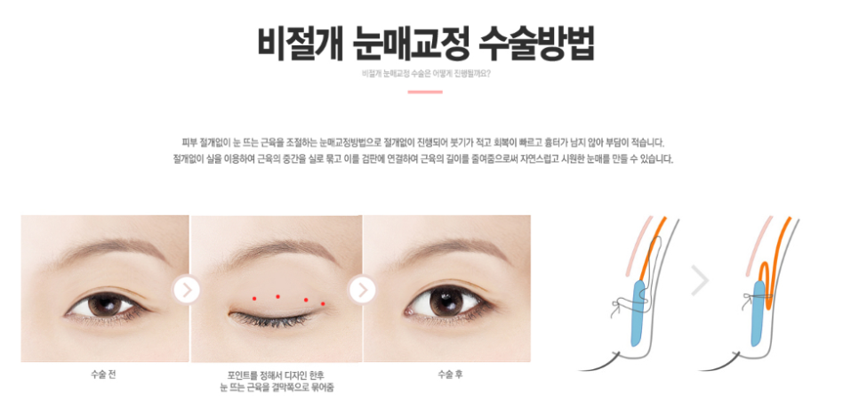 잘생김이 10배가 되는 베리굿 남자 눈매교정 관련 이미지 3