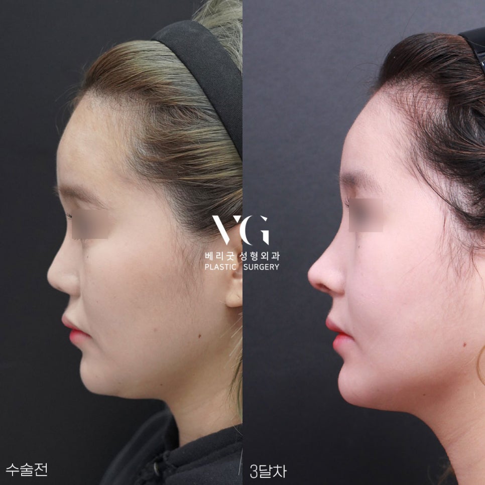 베리굿성형외과의 VERYGOOD한! 자가늑코재수술 전후 관련 이미지 4