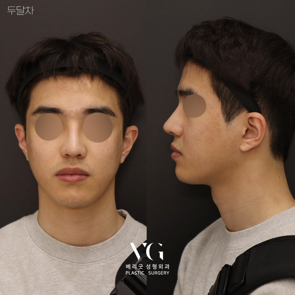 [ 베리굿성형외과 ] 안면윤곽 3종 Special한 REAL 전후비교 관련 이미지 7