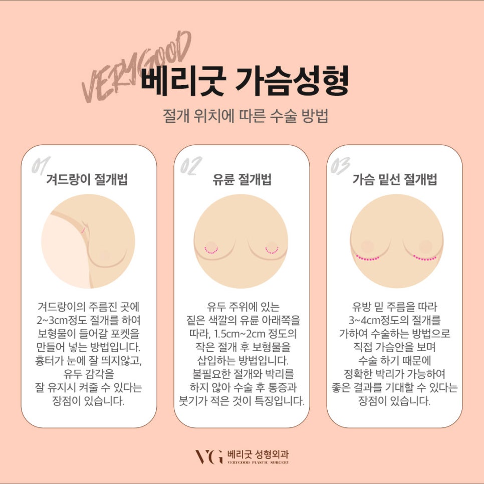 가슴성형 가격/ 가슴성형 잘하는곳 관련 이미지 4