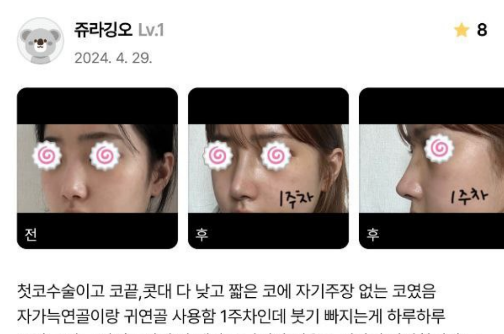 첫코수술 낮은코수술 자가늑연골 귀연골 베리굿성형외과 전후후기 관련 이미지 4