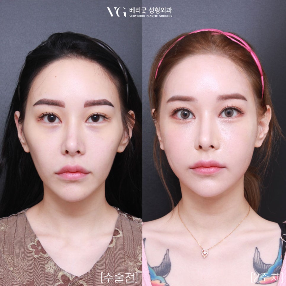 [베리굿성형외과]안면윤곽 리얼전후! 관련 이미지 1