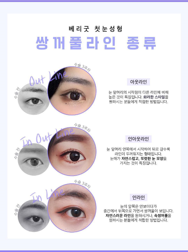 첫눈수술 절개?자연유착? 적합한 수술방법으로 관련 이미지 2