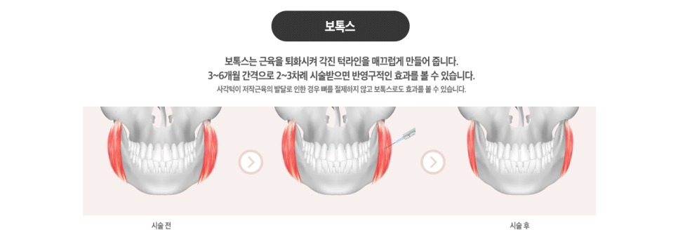 [ 베리굿성형외과 ] 안면윤곽 3종 Special한 REAL 전후비교 관련 이미지 6