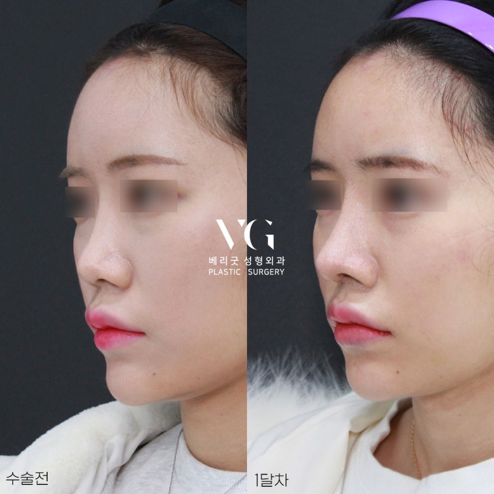 베리굿성형외과의 VERYGOOD한! 자가늑코재수술 전후 관련 이미지 1