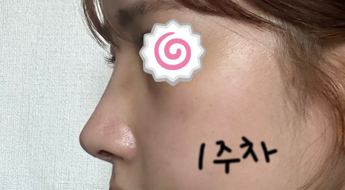 첫코수술 낮은코수술 자가늑연골 귀연골 베리굿성형외과 전후후기 관련 이미지 3