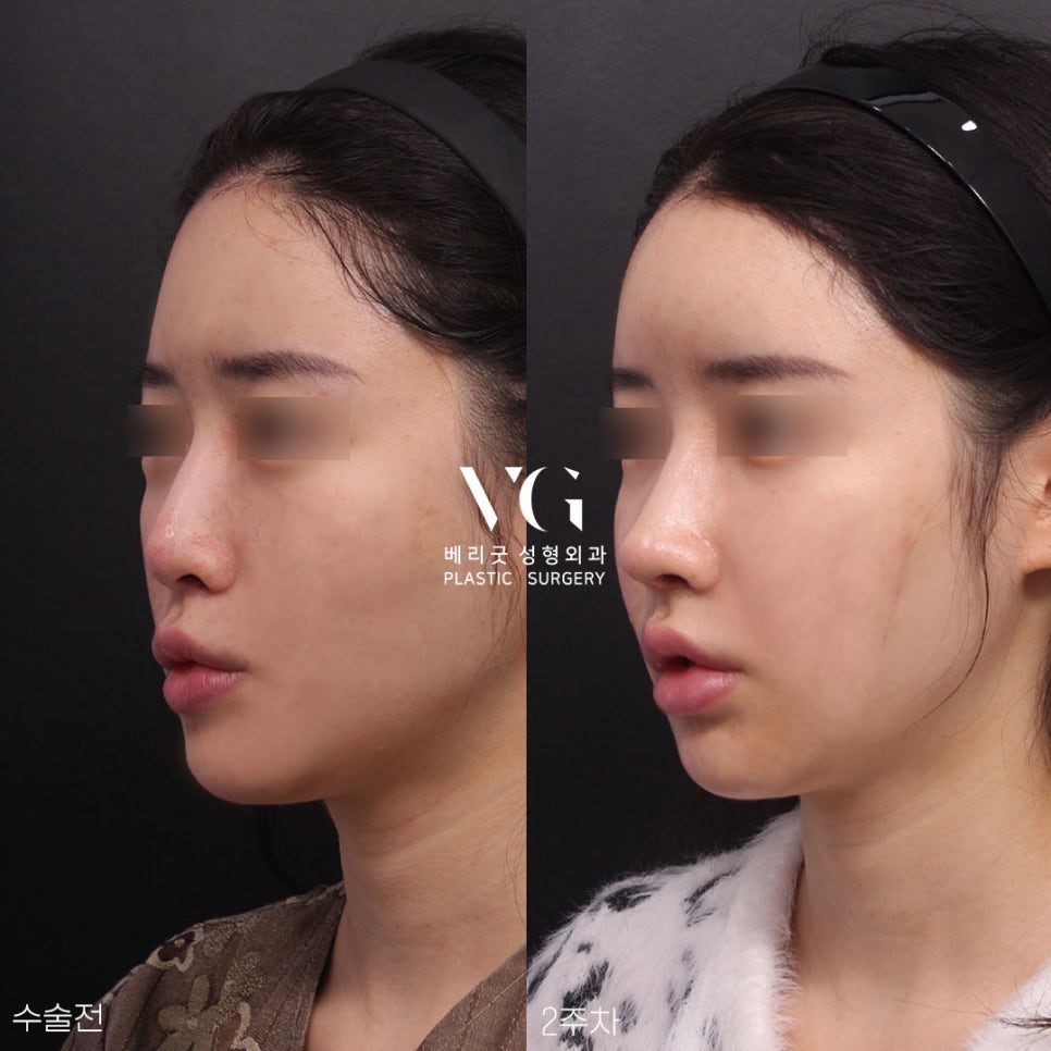 베리굿성형외과의 VERYGOOD한! 자가늑코재수술 전후 관련 이미지 6