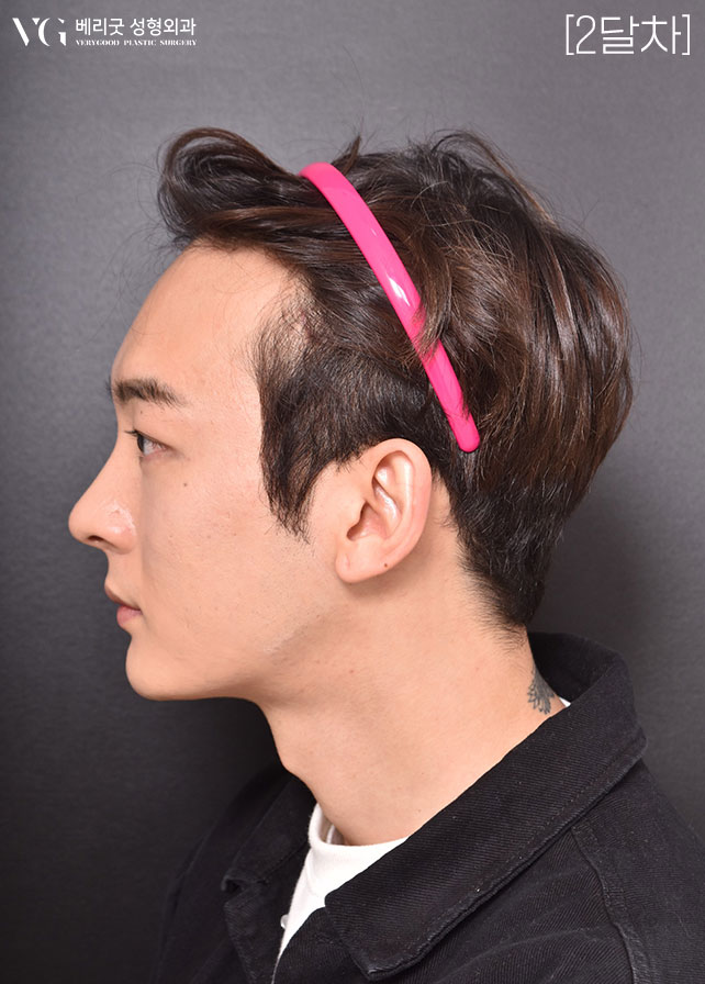 [베리굿성형외과]안면윤곽 리얼전후! 관련 이미지 16