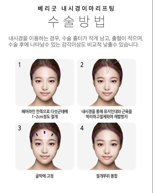 깊은 이마주름 베리굿성형외과에서 매끈하게! 관련 이미지 2