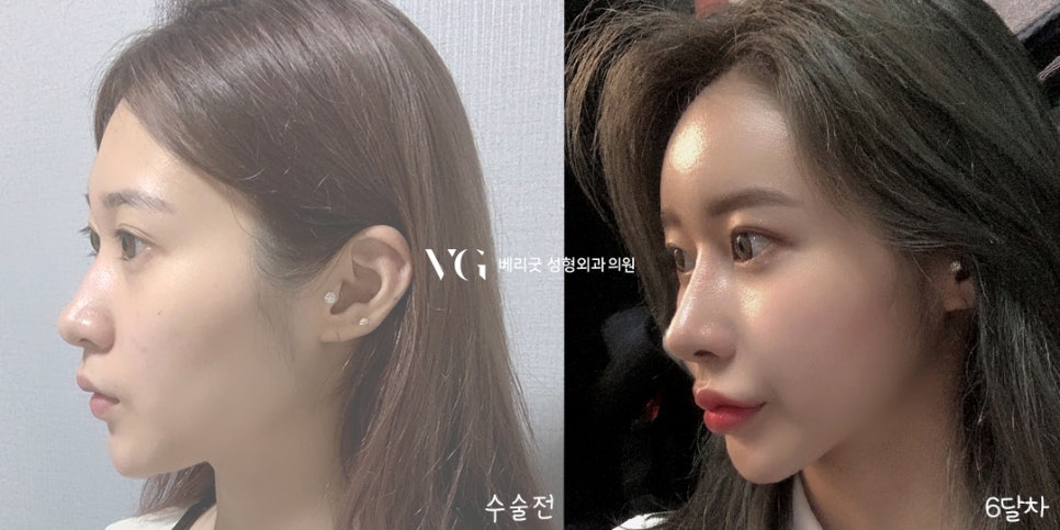 교정 없이! 발치 없이! 코성형으로 돌출입교정하자 ❤베리굿성형외과❤ 관련 이미지 8