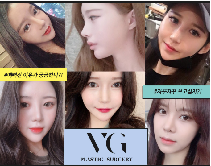 풀페이스리프팅 베리굿성형외과에서 동안얼굴 완성~! 관련 이미지 12