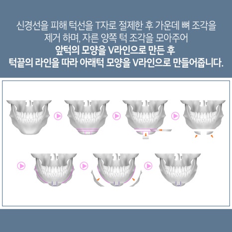 안면윤곽3종으로 매끄럽게 만족스러운 결과 관련 이미지 8