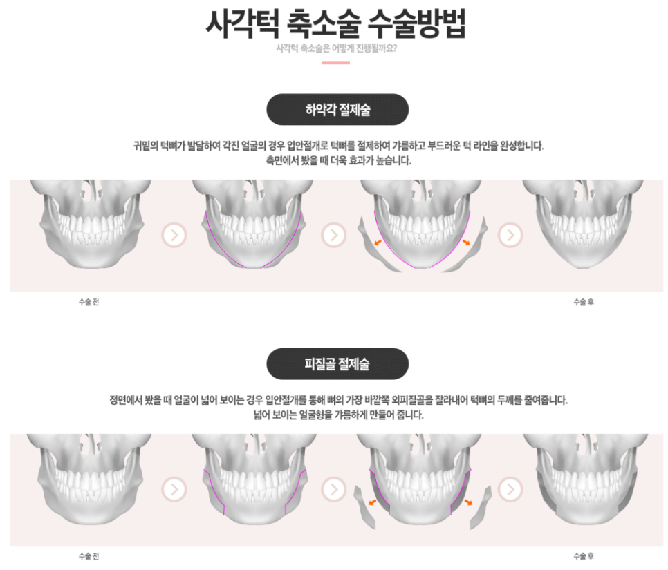 사각턱축소 내게 맞는 라인으로 관련 이미지 3