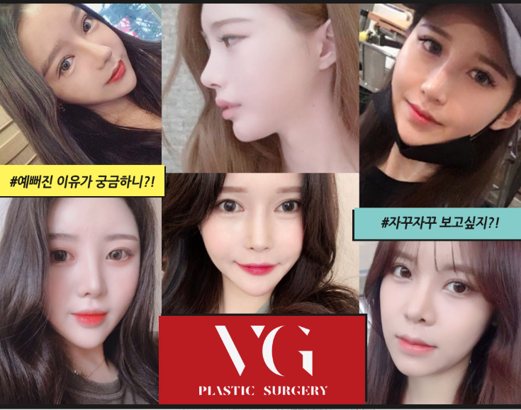 베리굿성형외과 엑설런트 코재수술 이벤트! 내생에 마지막 코수술! 관련 이미지 9