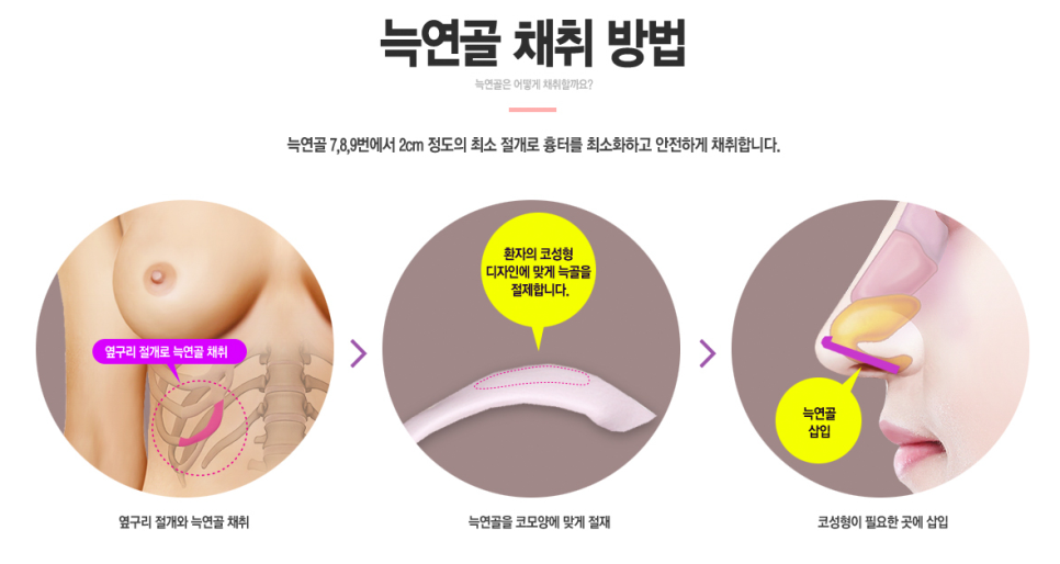 베리굿에서 자가늑연골로 베리굿하게 코수술하자💜 관련 이미지 4