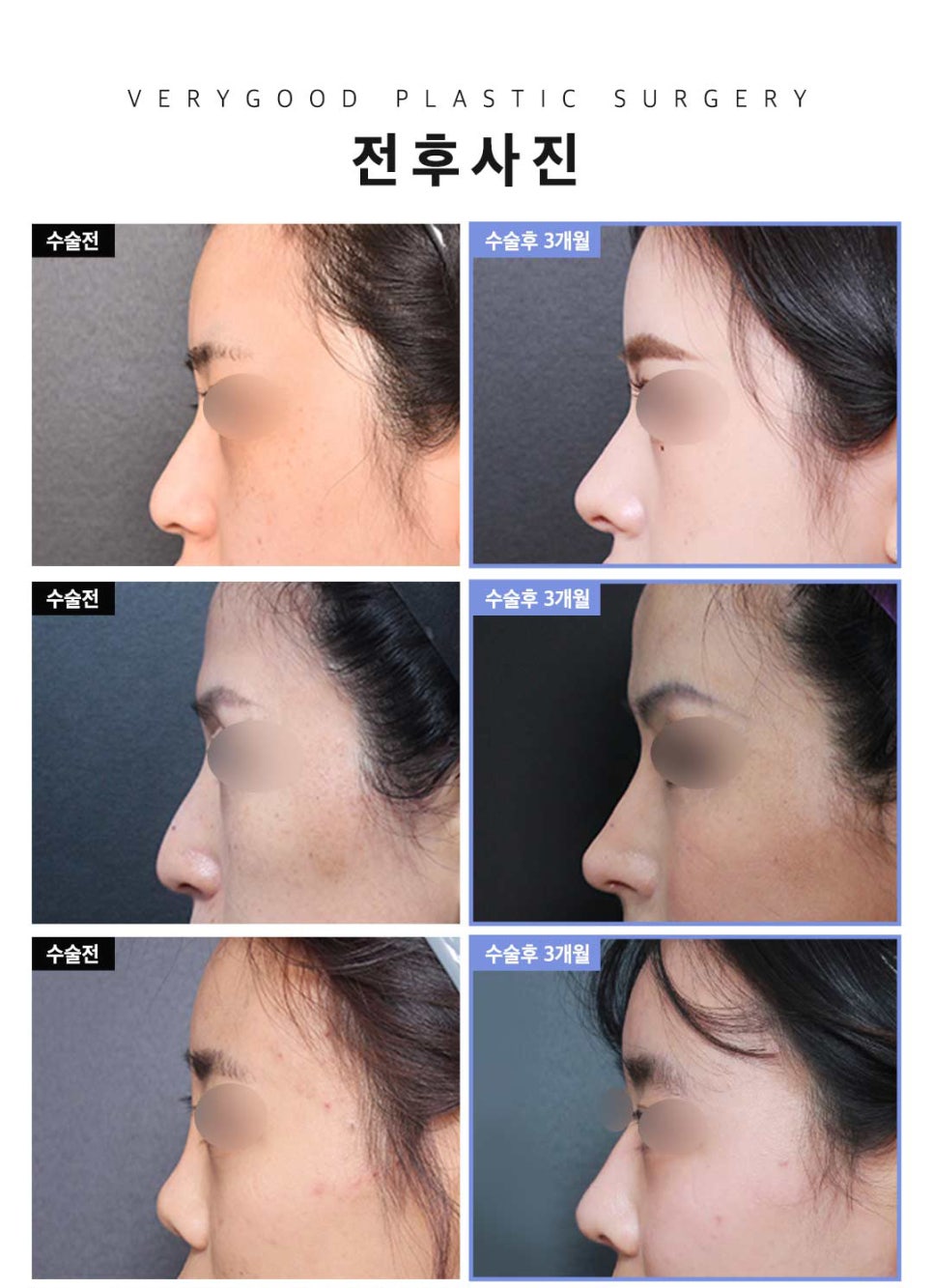 자가연골 코재수술, 기능코 또는 비염까지 한번에 해결 / 강남역 이비인후과 관련 이미지 6
