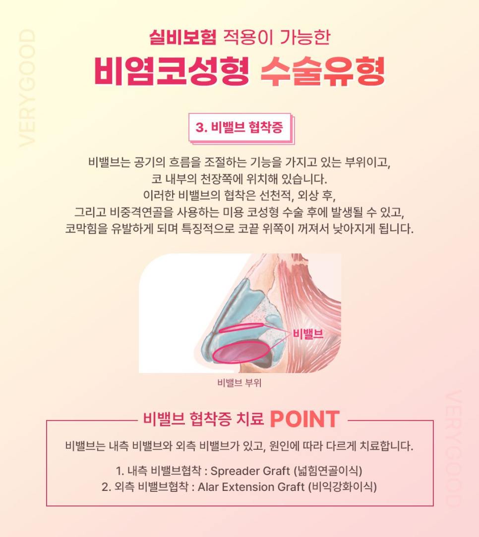 콧물&middot;코막힘&middot;재채기&hellip;비염도 치료하고 코모양도 예뻐지고 싶다면? 강남 비염코성형 관련 이미지 6