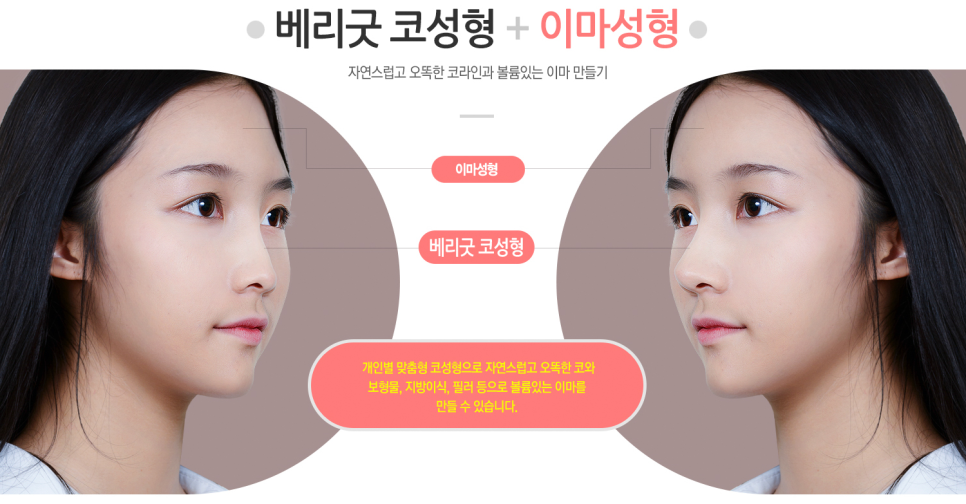교정 없이! 발치 없이! 코성형으로 돌출입교정하자 ❤베리굿성형외과❤ 관련 이미지 3