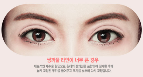 눈재수술, 원인과 상태에 따라 방법도 바뀐다? 관련 이미지 3