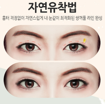 눈성형잘하는곳 잘고르는법 관련 이미지 5
