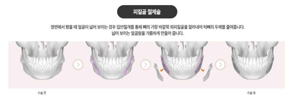 [ 베리굿성형외과 ] 안면윤곽 3종 Special한 REAL 전후비교 관련 이미지 5