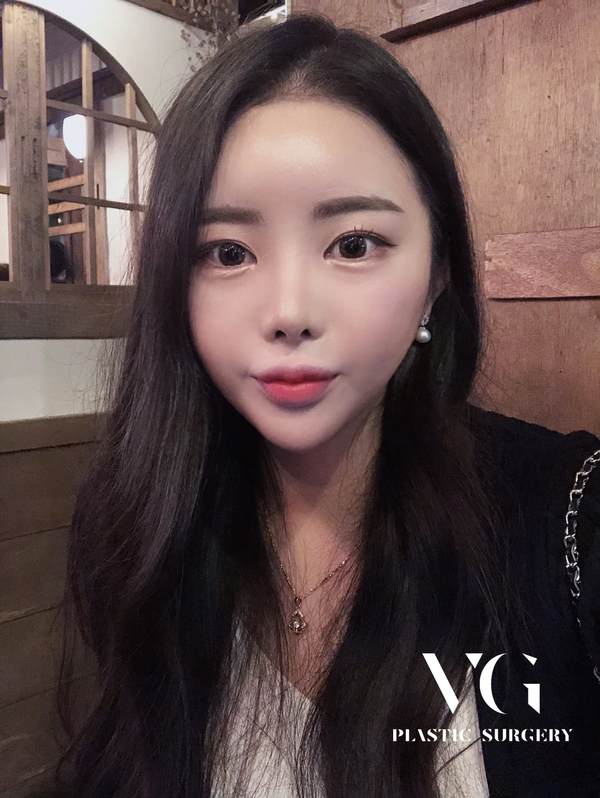 PRP지방이식으로 생착률 UP! 생기 UP! 관련 이미지 2