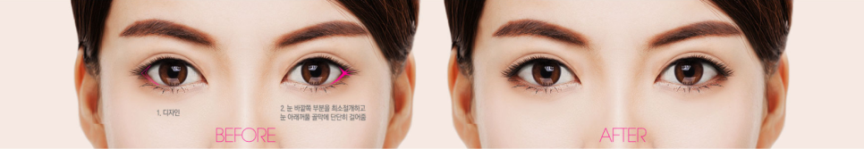 트임성형 시원하고 또렷한 눈매로 개선 관련 이미지 3