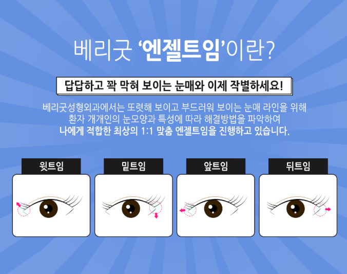 베리굿성형외과 트임성형! 내가 원하던 천사눈망울, 엔젤트임 김준현원장님 관련 이미지 3