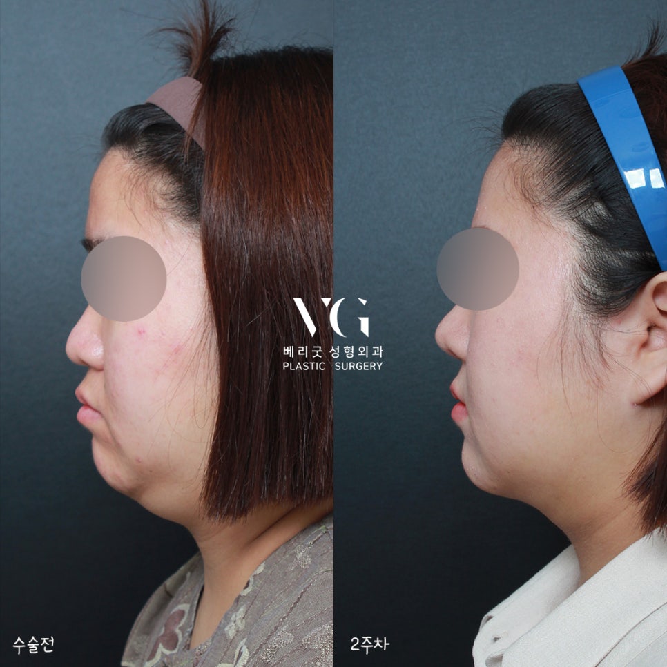 베리굿 얼굴지방흡입 전후💖밖에서 언제까지 마스크 쓸래? 관련 이미지 1