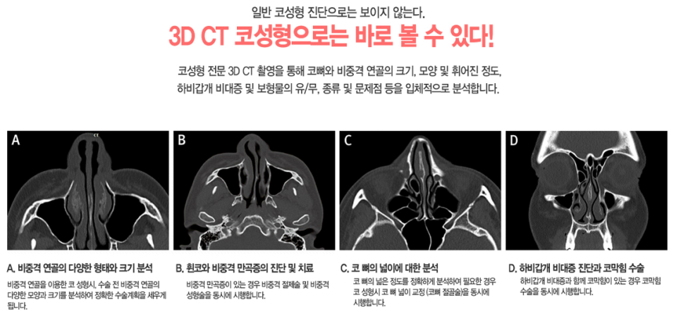 코성형 꼼꼼하게 알고 하자 관련 이미지 3