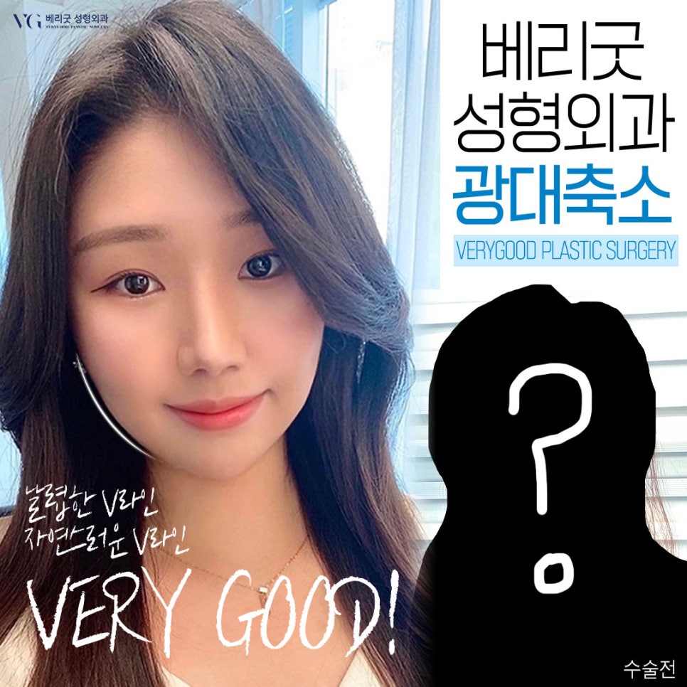 강남역광대축소 후기가 궁금해? 베리굿 광대축소💖 관련 이미지 1