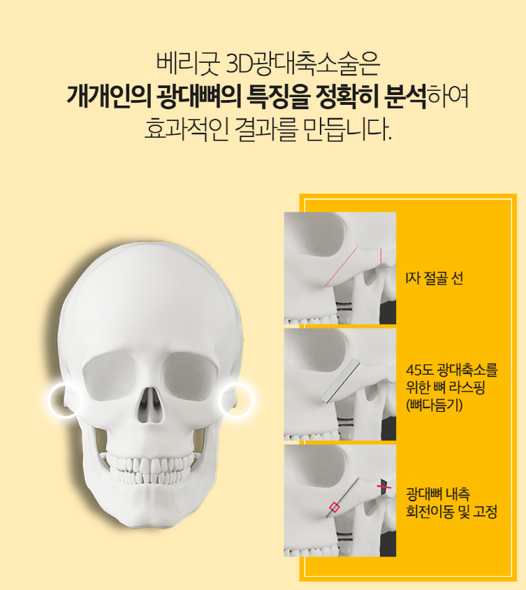 안면윤곽 매끄럽고 아름답게! 관련 이미지 7