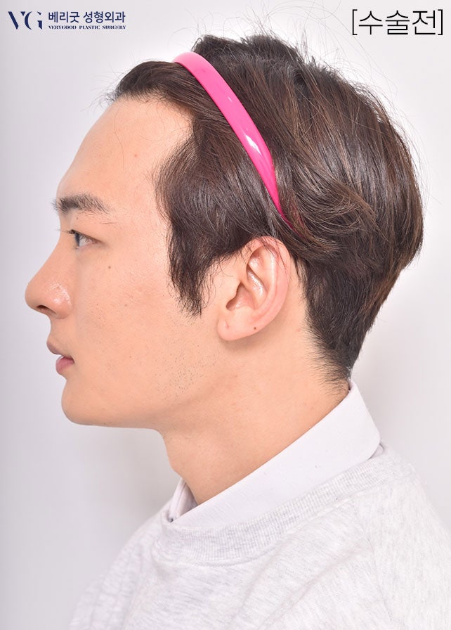 [베리굿성형외과]안면윤곽 리얼전후! 관련 이미지 11