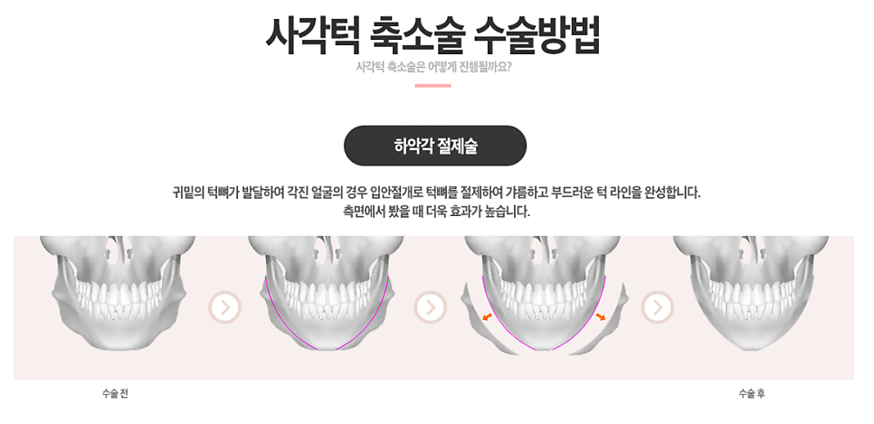 [베리굿성형외과]안면윤곽 리얼전후! 관련 이미지 12