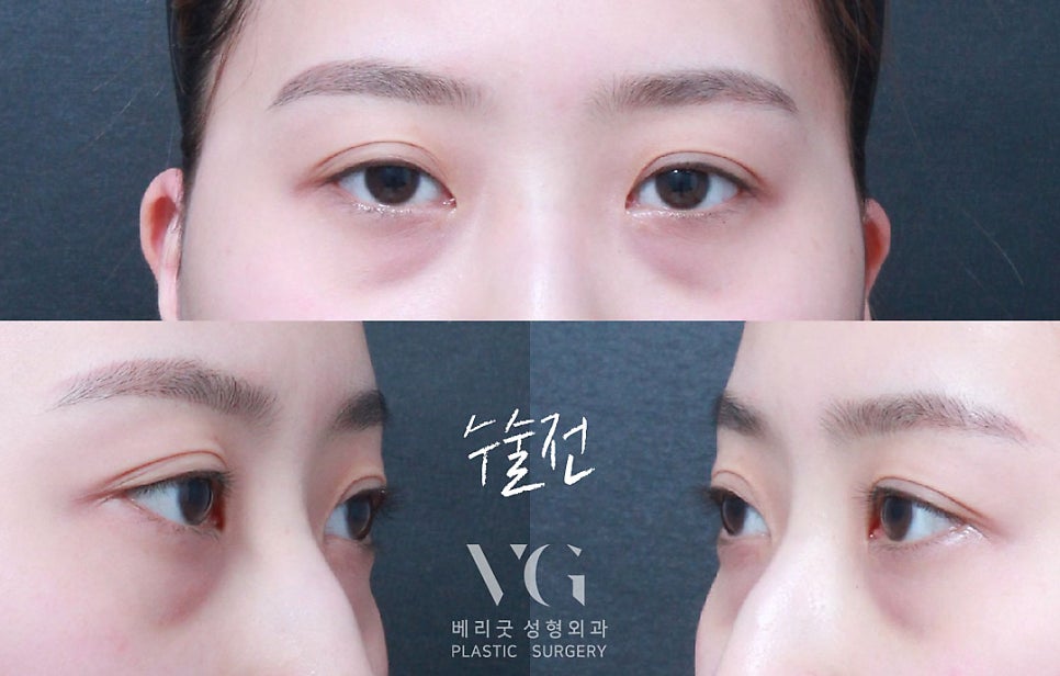다크서클 없애는 눈밑지방재배치(눈밑지)베리굿성형외과 전후✨ 관련 이미지 4