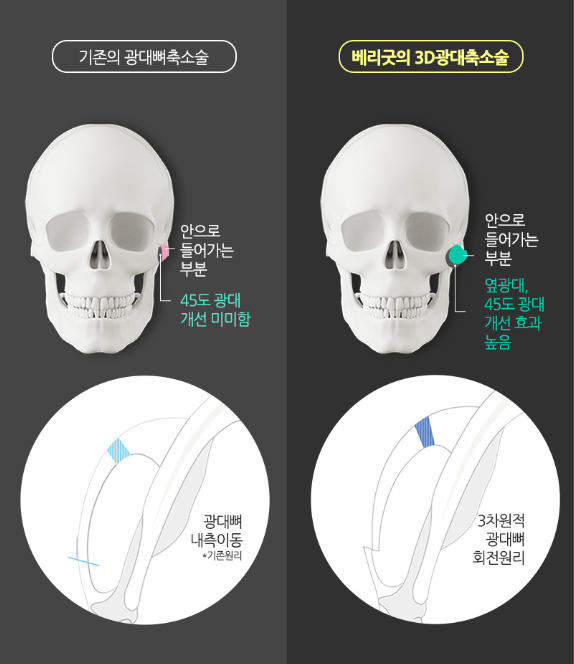 광대축소술 이젠 가리지말고 당당하게! 관련 이미지 4