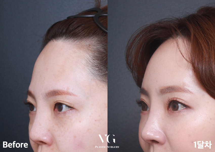 답답한 눈매? 무거운 눈? 베리굿 이마거상전후로 해결👀💖 관련 이미지 3