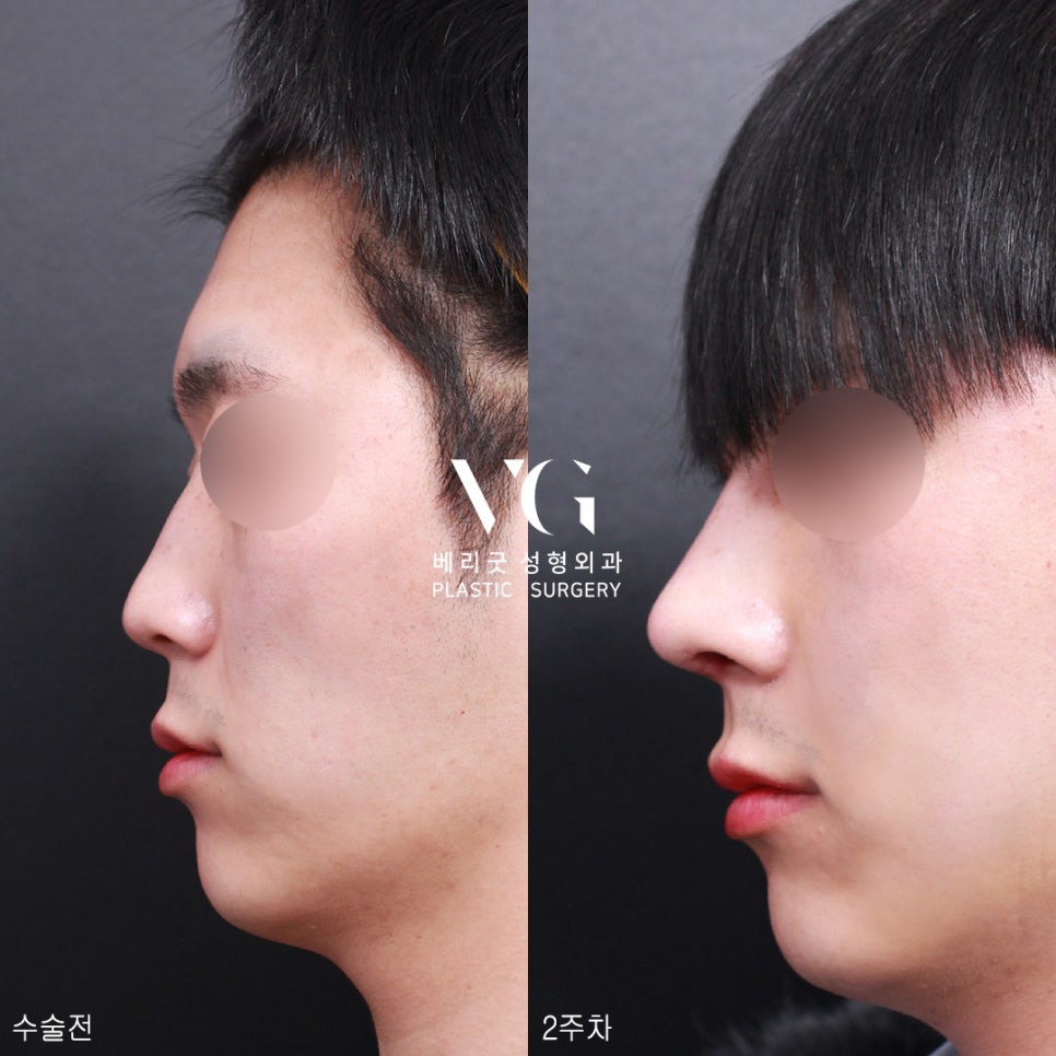 남자코성형전후가 궁금해?남자코성형도 베리굿성형외과💙 관련 이미지 5