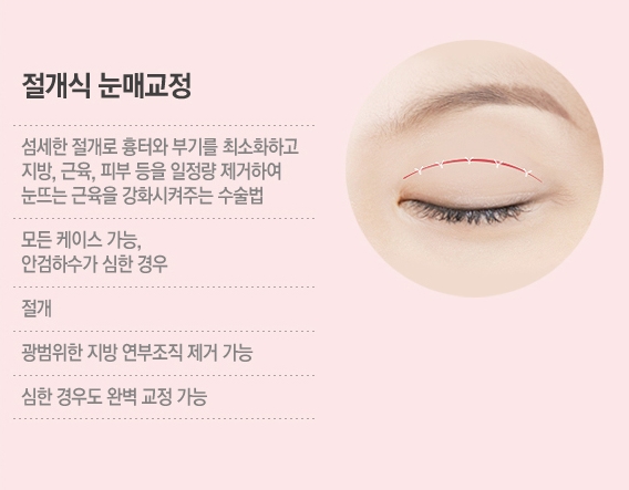 [베리굿성형외과 강남눈매교정]누구나 반하는 또렷한 눈매만들기✨ 관련 이미지 7
