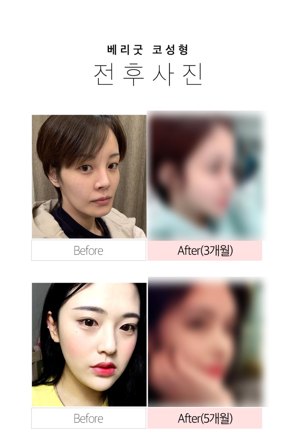비염코성형 원인 파악부터 비용까지 관련 이미지 12