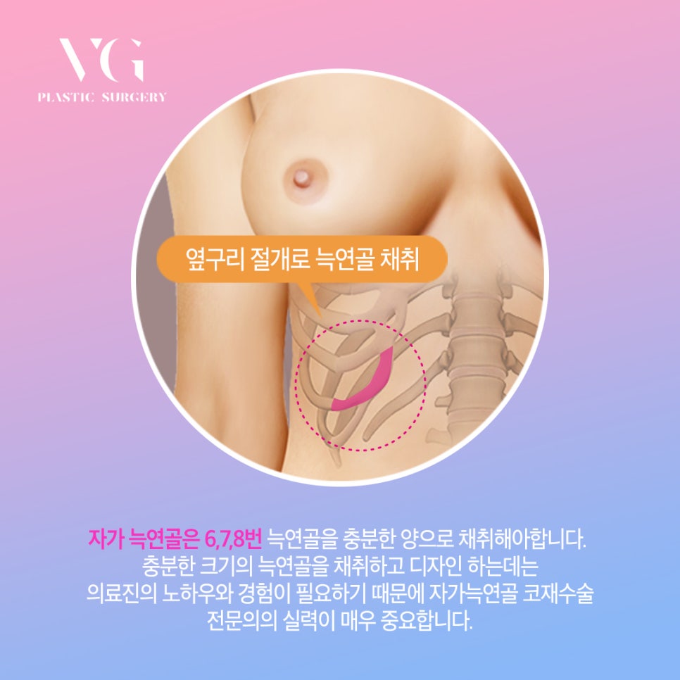 자가늑연골 코성형의 모든것 (코재수술 2탄!) 관련 이미지 5