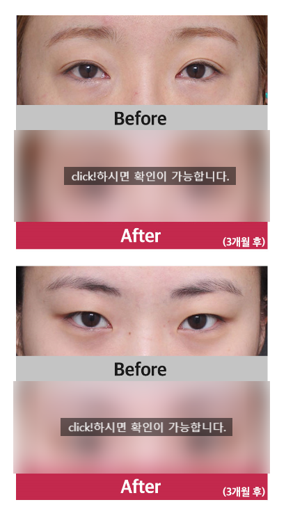 시원한 눈매? 베리굿 트리플 트임 관련 이미지 6