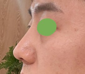 Primary Rhinoplasty, Tip Surgery, Osteotomy, Hump Correction, Donor Rib Cartilage | 베리굿성형외과 Before-and-After Review image 2